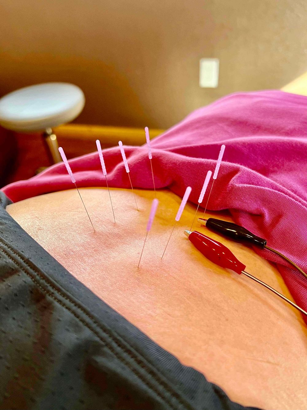 Dry needling with electrical stimulation for enhanced muscle relaxation